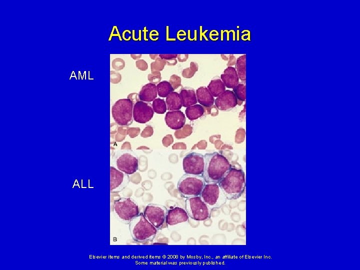 Acute Leukemia AML ALL Elsevier items and derived items © 2008 by Mosby, Inc.
