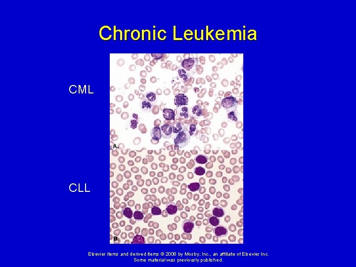 Chronic Leukemia CML CLL Elsevier items and derived items © 2008 by Mosby, Inc.
