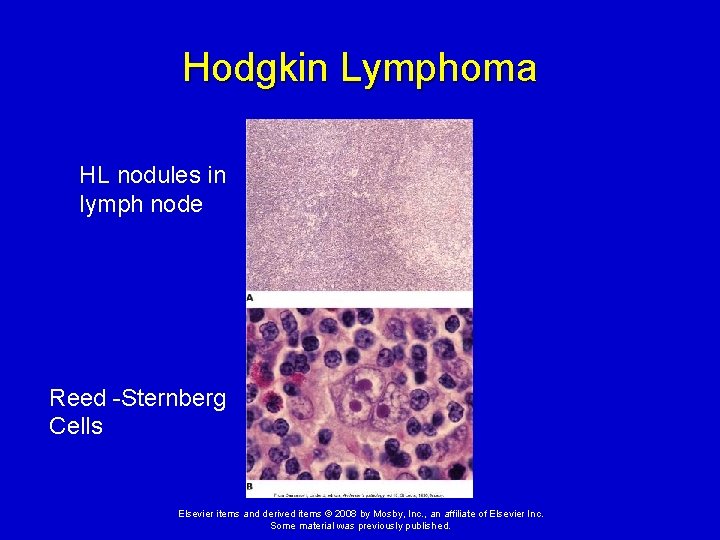 Hodgkin Lymphoma HL nodules in lymph node Reed -Sternberg Cells Elsevier items and derived