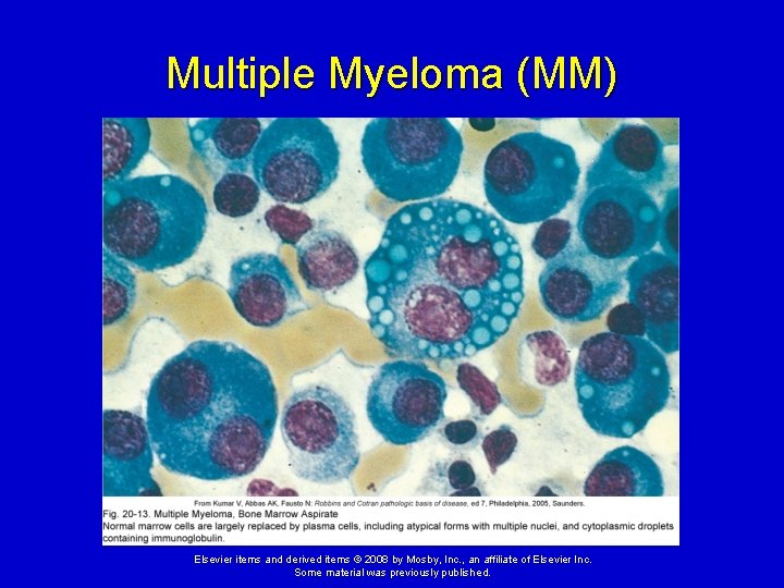 Multiple Myeloma (MM) Elsevier items and derived items © 2008 by Mosby, Inc. ,