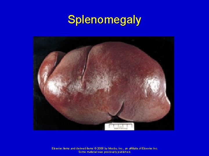 Splenomegaly Elsevier items and derived items © 2008 by Mosby, Inc. , an affiliate