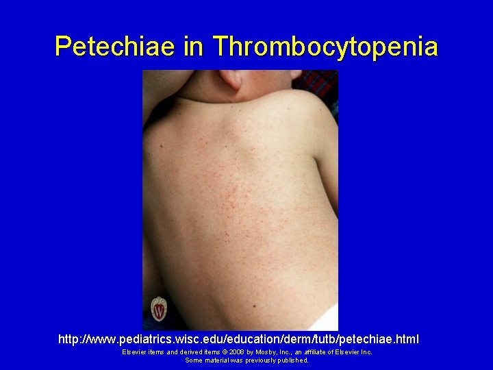 Petechiae in Thrombocytopenia http: //www. pediatrics. wisc. edu/education/derm/tutb/petechiae. html Elsevier items and derived items