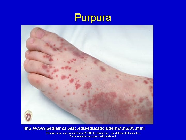 Purpura http: //www. pediatrics. wisc. edu/education/derm/tutb/85. html Elsevier items and derived items © 2008