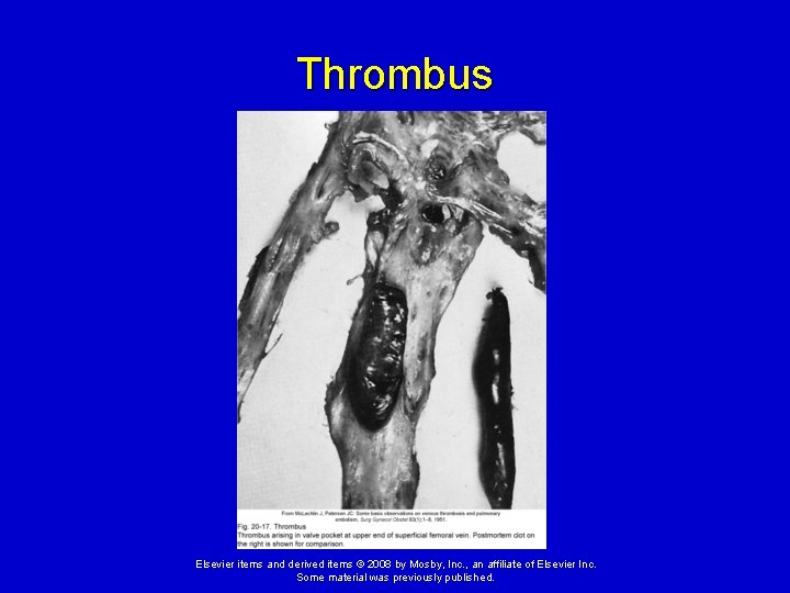 Thrombus Elsevier items and derived items © 2008 by Mosby, Inc. , an affiliate