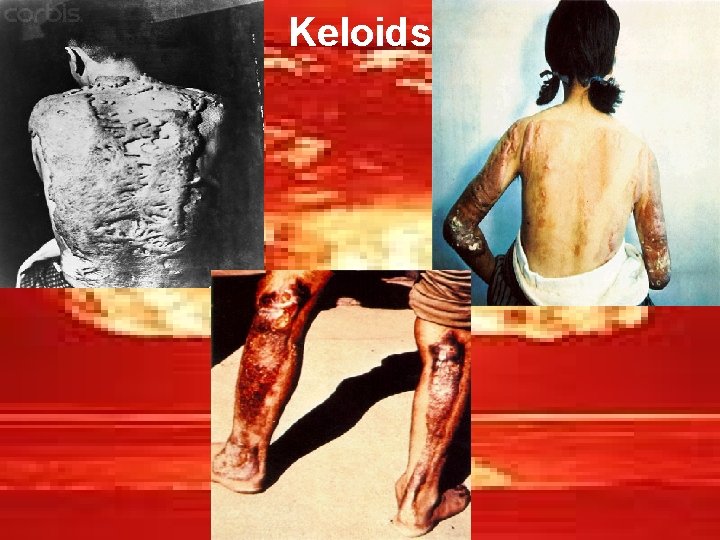 Keloids 