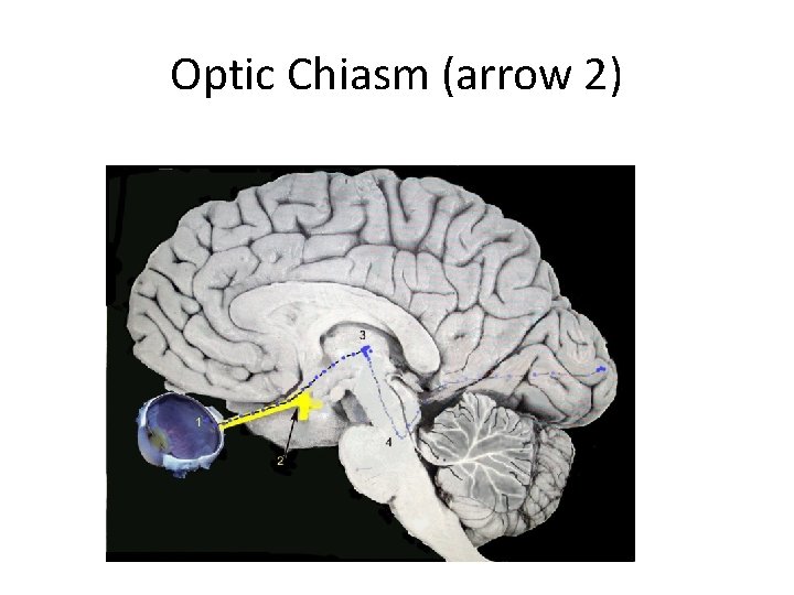 Optic Chiasm (arrow 2) 