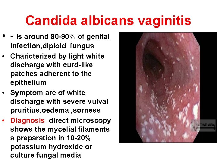 Candida albicans vaginitis • - is around 80 -90% of genital infection, diploid fungus