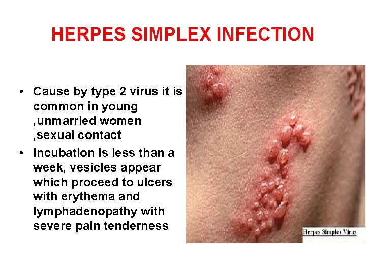 HERPES SIMPLEX INFECTION • Cause by type 2 virus it is common in young