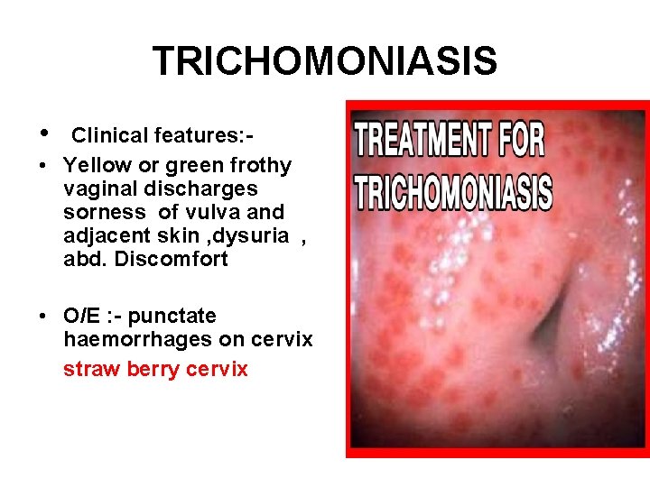 TRICHOMONIASIS • Clinical features: • Yellow or green frothy vaginal discharges sorness of vulva