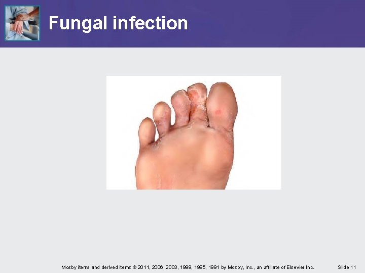 Fungal infection Mosby items and derived items © 2011, 2006, 2003, 1999, 1995, 1991