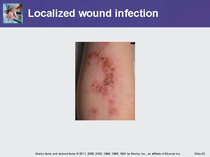 Localized wound infection Mosby items and derived items © 2011, 2006, 2003, 1999, 1995,