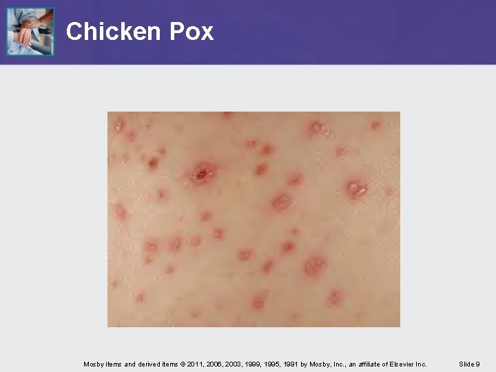 Chicken Pox Mosby items and derived items © 2011, 2006, 2003, 1999, 1995, 1991