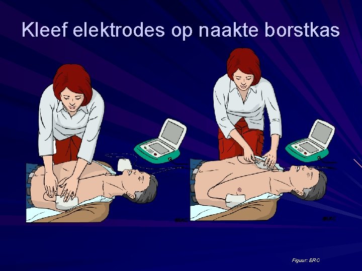 Kleef elektrodes op naakte borstkas Figuur: ERC 