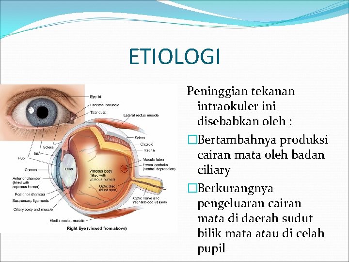 ETIOLOGI Peninggian tekanan intraokuler ini disebabkan oleh : �Bertambahnya produksi cairan mata oleh badan