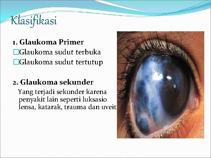 Klasifikasi 1. Glaukoma Primer �Glaukoma sudut terbuka �Glaukoma sudut tertutup 2. Glaukoma sekunder Yang