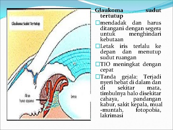 Glaukoma sudut tertutup �mendadak dan harus ditangani dengan segera untuk menghindari kebutaan �Letak iris