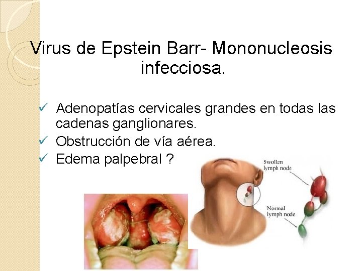 Virus de Epstein Barr- Mononucleosis infecciosa. ü Adenopatías cervicales grandes en todas las cadenas
