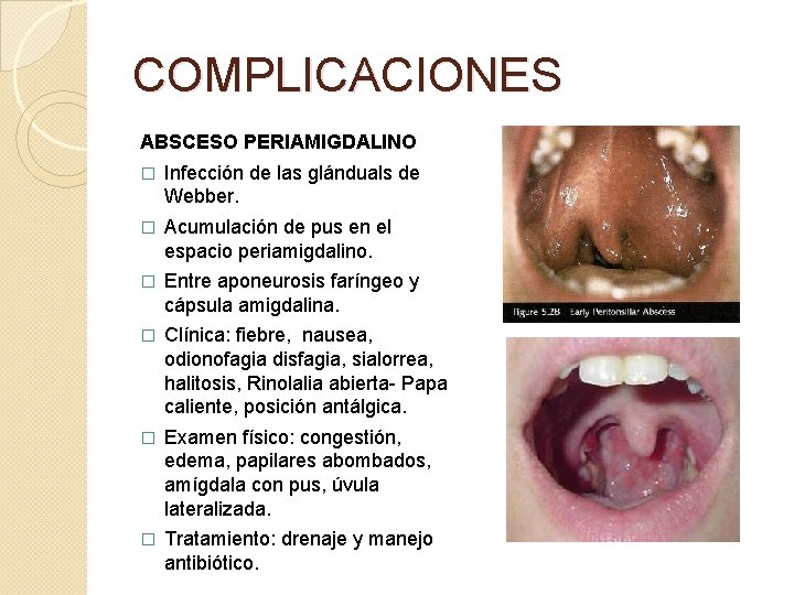 COMPLICACIONES ABSCESO PERIAMIGDALINO � Infección de las glánduals de Webber. � Acumulación de pus
