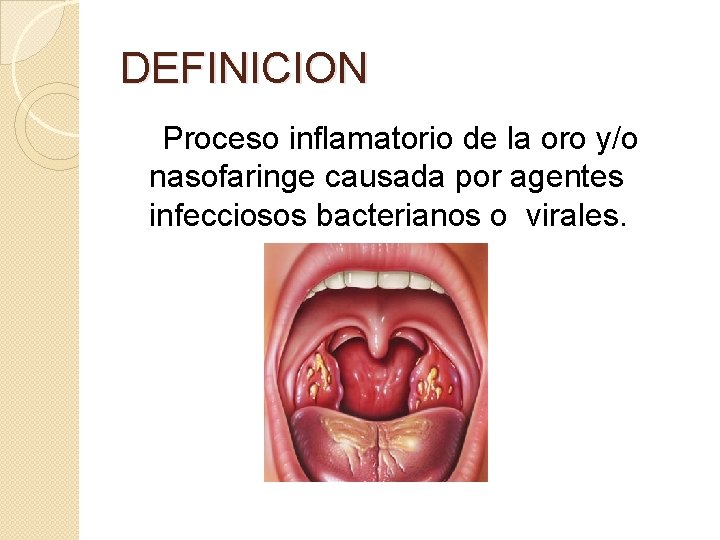 DEFINICION Proceso inflamatorio de la oro y/o nasofaringe causada por agentes infecciosos bacterianos o