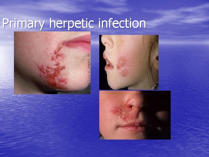 Primary herpetic infection 
