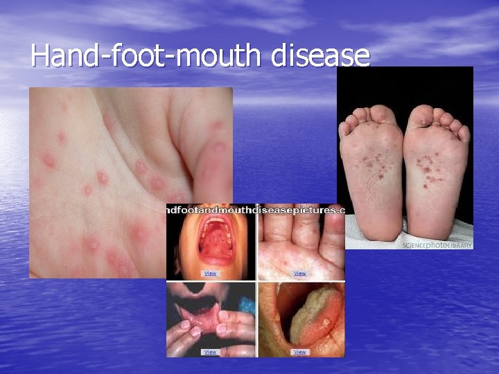Hand-foot-mouth disease 