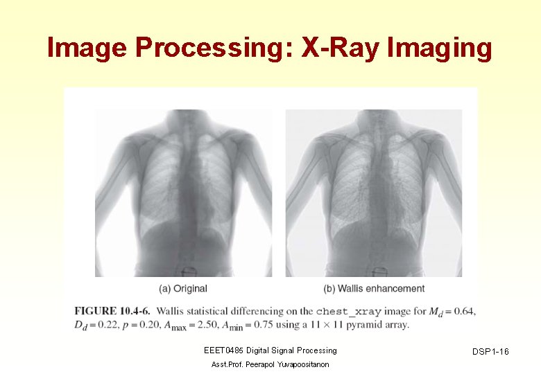 Image Processing: X-Ray Imaging EEET 0485 Digital Signal Processing Asst. Prof. Peerapol Yuvapoositanon DSP
