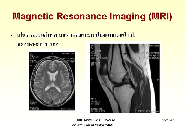 Magnetic Resonance Imaging (MRI) • เปนเครองมอสำหรบถายภาพอวยวะภายในของมนษยโดยไ มตองอาศยการผาตด EEET 0485 Digital Signal Processing Asst. Prof.