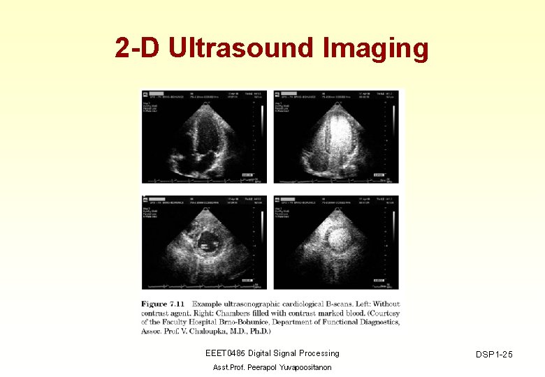 2 -D Ultrasound Imaging EEET 0485 Digital Signal Processing Asst. Prof. Peerapol Yuvapoositanon DSP