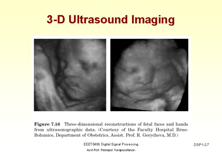 3 -D Ultrasound Imaging EEET 0485 Digital Signal Processing Asst. Prof. Peerapol Yuvapoositanon DSP