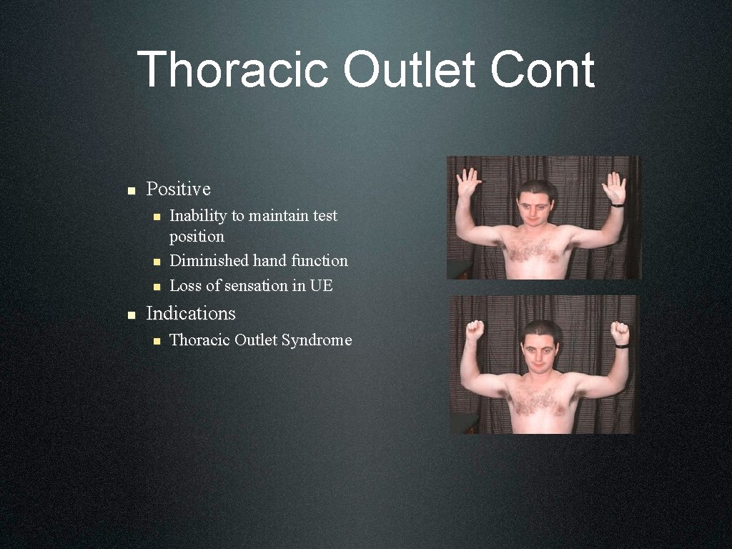 Thoracic Outlet Cont n Positive n n Inability to maintain test position Diminished hand