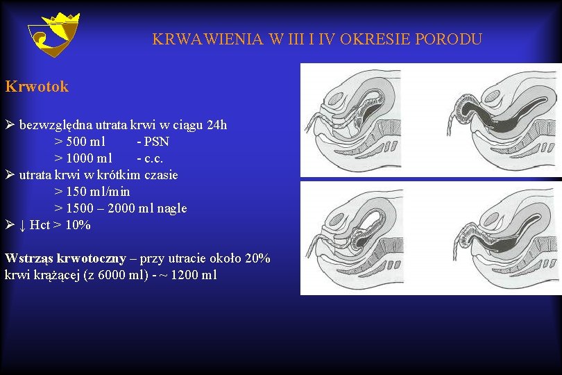 KRWAWIENIA W III I IV OKRESIE PORODU Krwotok Ø bezwzględna utrata krwi w ciągu