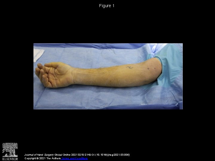 Figure 1 Journal of Hand Surgery Global Online 2021 3210 -214 DOI: (10. 1016/j.