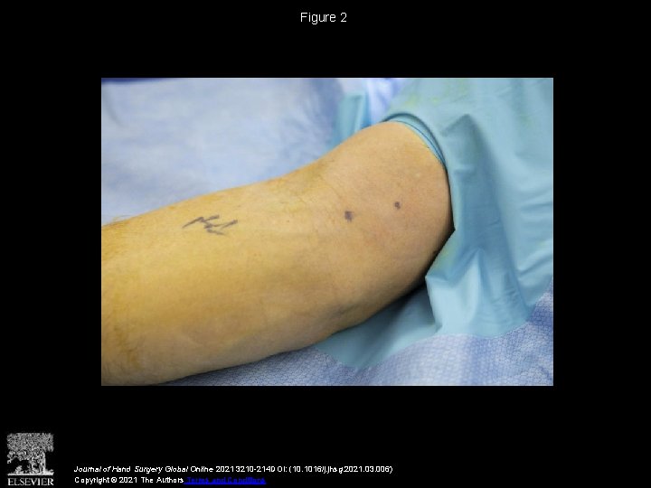 Figure 2 Journal of Hand Surgery Global Online 2021 3210 -214 DOI: (10. 1016/j.