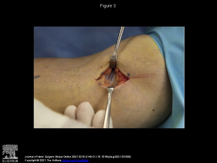 Figure 3 Journal of Hand Surgery Global Online 2021 3210 -214 DOI: (10. 1016/j.