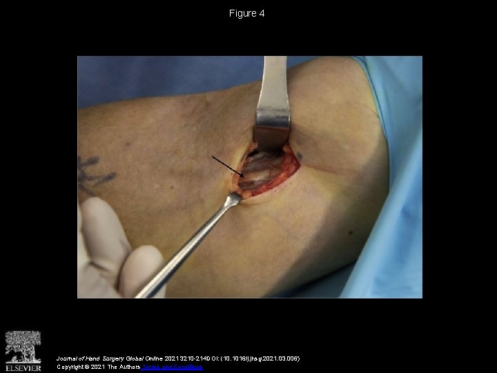 Figure 4 Journal of Hand Surgery Global Online 2021 3210 -214 DOI: (10. 1016/j.