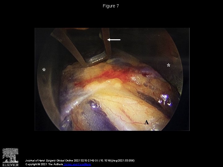 Figure 7 Journal of Hand Surgery Global Online 2021 3210 -214 DOI: (10. 1016/j.