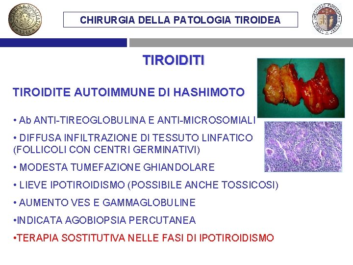 CHIRURGIA DELLA PATOLOGIA TIROIDEA TIROIDITI TIROIDITE AUTOIMMUNE DI HASHIMOTO • Ab ANTI-TIREOGLOBULINA E ANTI-MICROSOMIALI