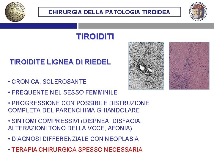 CHIRURGIA DELLA PATOLOGIA TIROIDEA TIROIDITI TIROIDITE LIGNEA DI RIEDEL • CRONICA, SCLEROSANTE • FREQUENTE