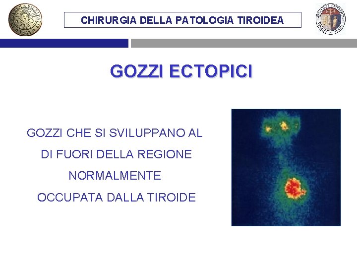 CHIRURGIA DELLA PATOLOGIA TIROIDEA GOZZI ECTOPICI GOZZI CHE SI SVILUPPANO AL DI FUORI DELLA