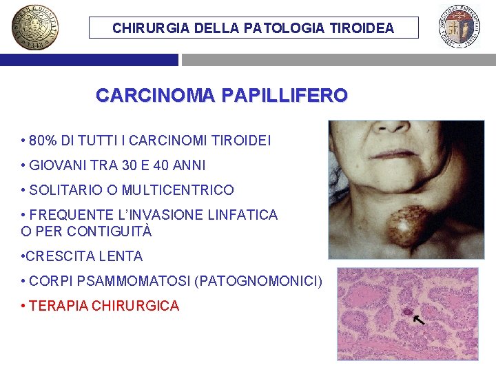 CHIRURGIA DELLA PATOLOGIA TIROIDEA CARCINOMA PAPILLIFERO • 80% DI TUTTI I CARCINOMI TIROIDEI •