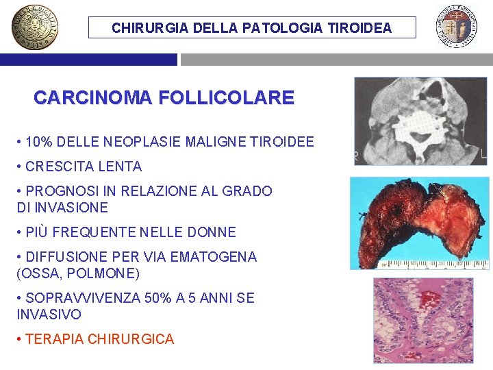 CHIRURGIA DELLA PATOLOGIA TIROIDEA CARCINOMA FOLLICOLARE • 10% DELLE NEOPLASIE MALIGNE TIROIDEE • CRESCITA