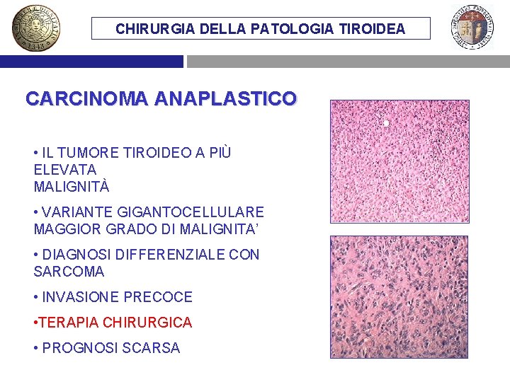 CHIRURGIA DELLA PATOLOGIA TIROIDEA CARCINOMA ANAPLASTICO • IL TUMORE TIROIDEO A PIÙ ELEVATA MALIGNITÀ