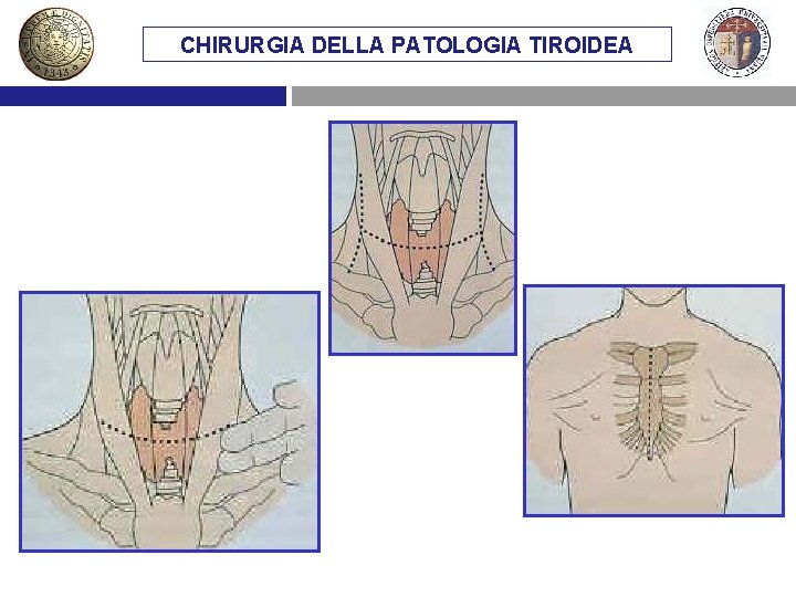 CHIRURGIA DELLA PATOLOGIA TIROIDEA 