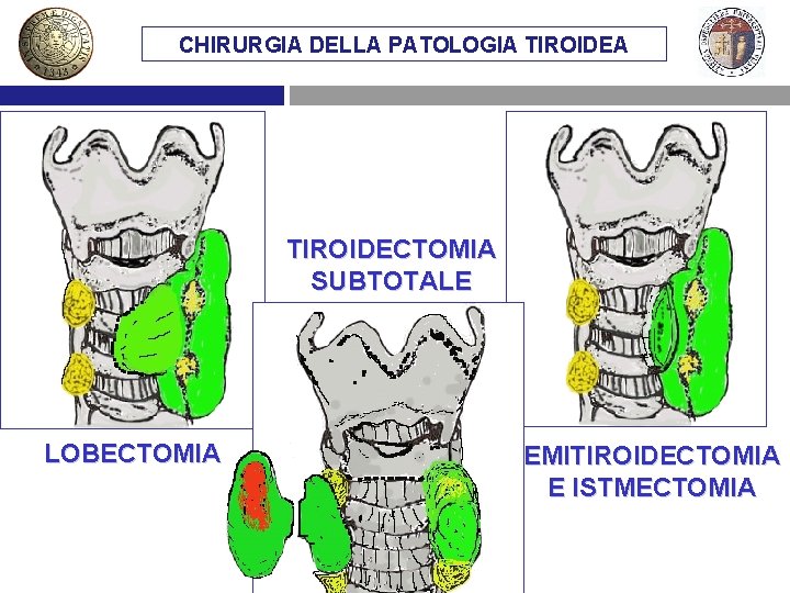 CHIRURGIA DELLA PATOLOGIA TIROIDECTOMIA SUBTOTALE LOBECTOMIA EMITIROIDECTOMIA E ISTMECTOMIA 