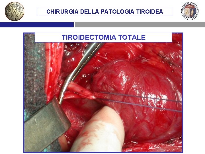 CHIRURGIA DELLA PATOLOGIA TIROIDECTOMIA TOTALE 