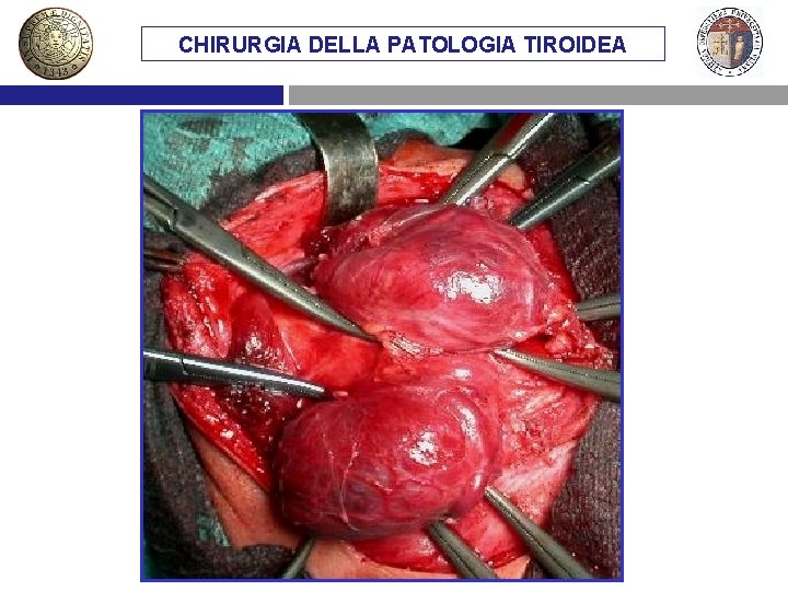 CHIRURGIA DELLA PATOLOGIA TIROIDEA 