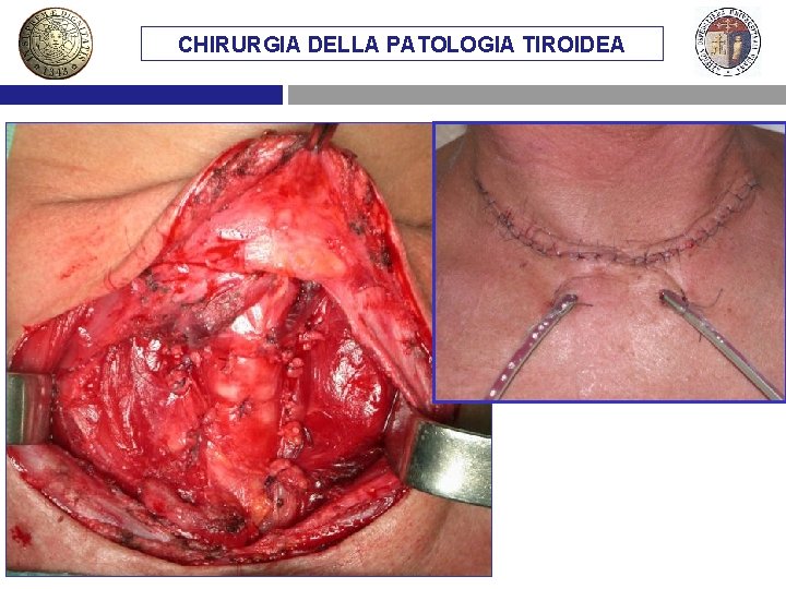 CHIRURGIA DELLA PATOLOGIA TIROIDEA 