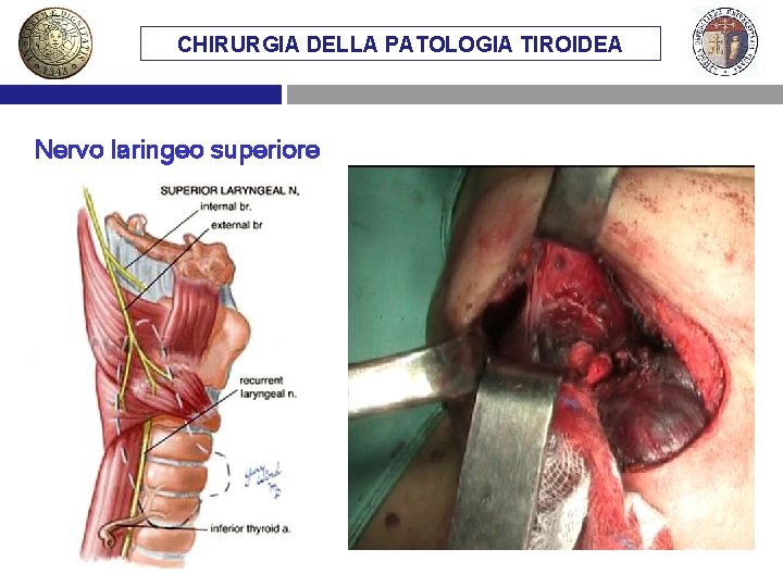 CHIRURGIA DELLA PATOLOGIA TIROIDEA Nervo laringeo superiore 