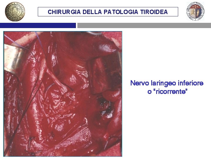 CHIRURGIA DELLA PATOLOGIA TIROIDEA Nervo laringeo inferiore o “ricorrente” 