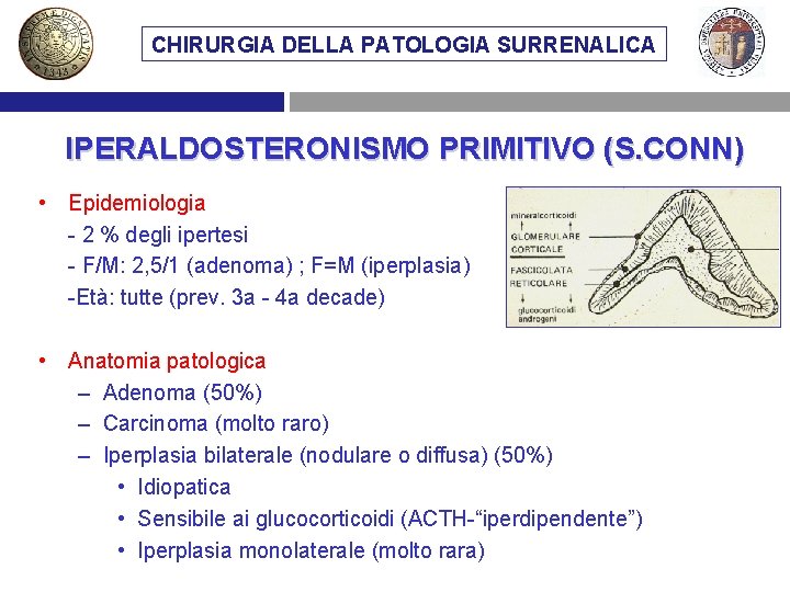 CHIRURGIA DELLA PATOLOGIA SURRENALICA IPERALDOSTERONISMO PRIMITIVO (S. CONN) • Epidemiologia - 2 % degli